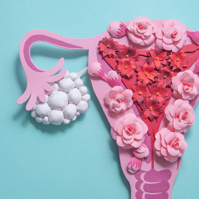 PCOS (2)